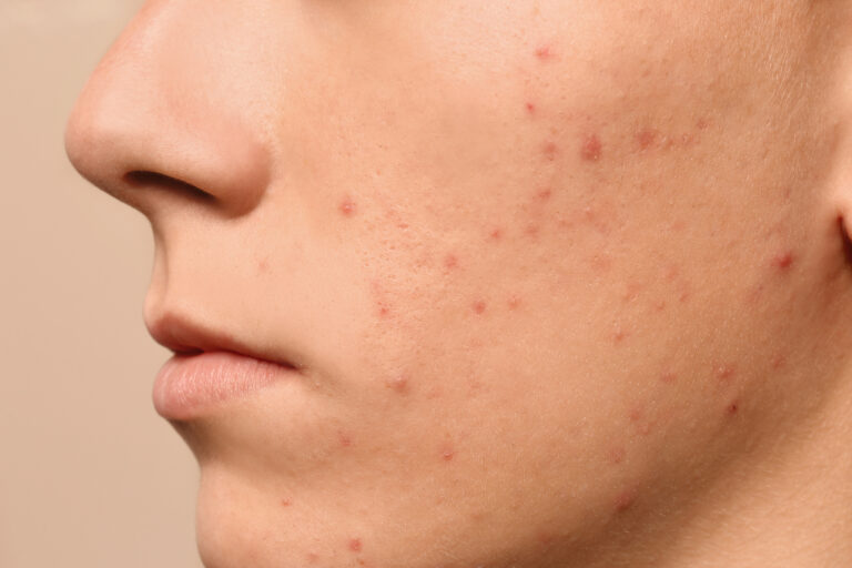 Rising acne cases seen among people in their 20s