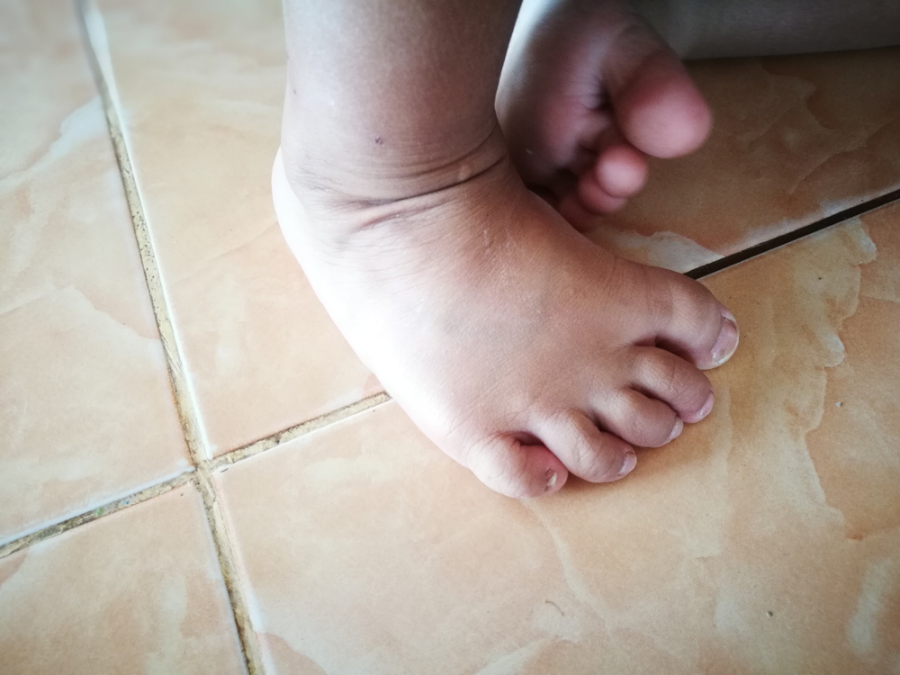 Congenital,Clubfoot,.abnormal,Foot,Or,Deformed,Feet.foot,Disease,Of,Children.