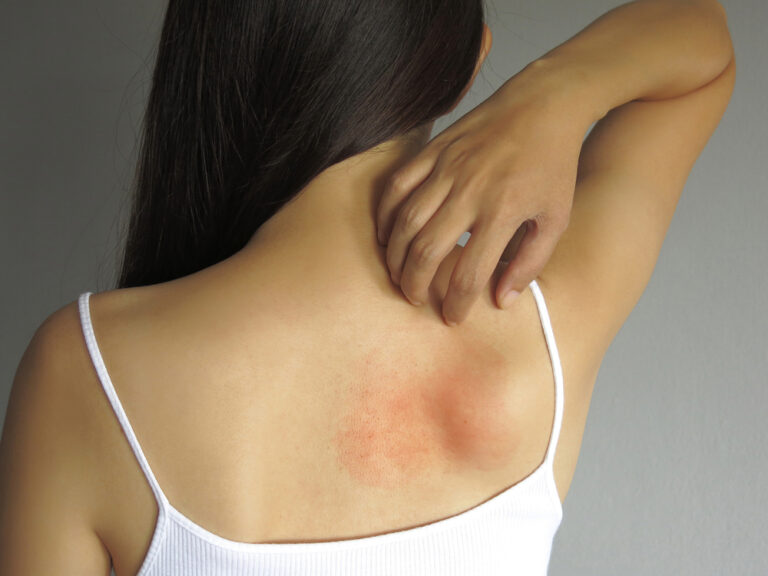 Why Scratching an Itch Feels So Good – But You Shouldn’t Do It