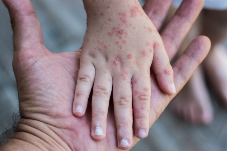 Tourists warned after measles outbreak hits holiday region