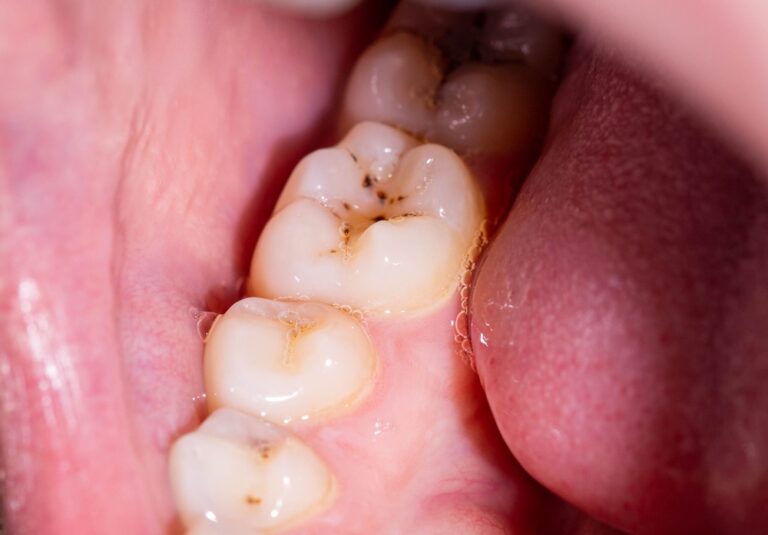 Goodbye to cavities? New gel shows promising results