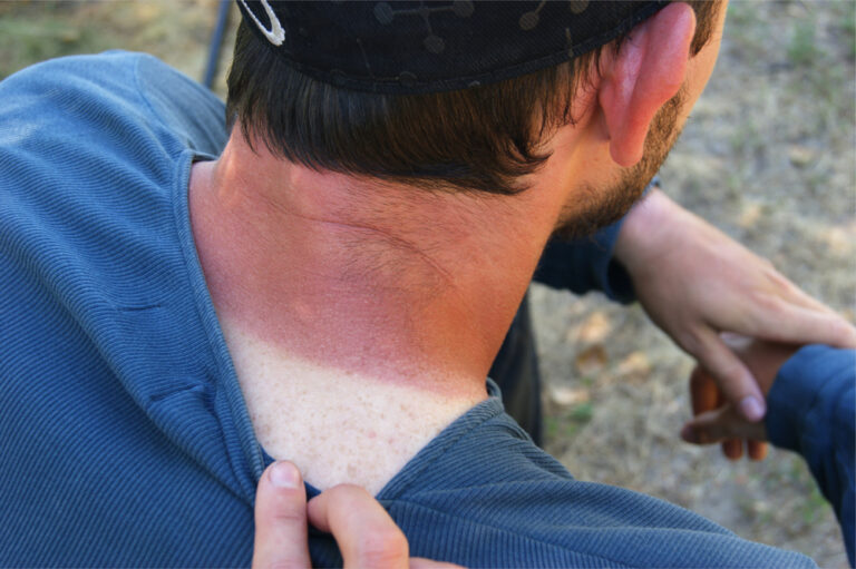 Doctors warn: Your skin remembers every sunburn