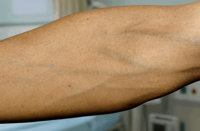 Hazelnut Rash How hazelnuts can affect your body if you eat them regularly