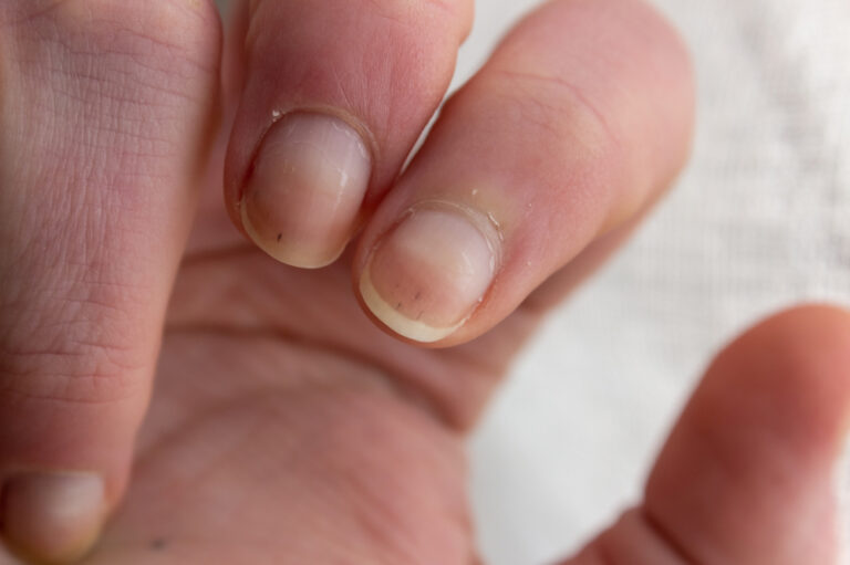 These nail changes may indicate underlying heart or liver conditions