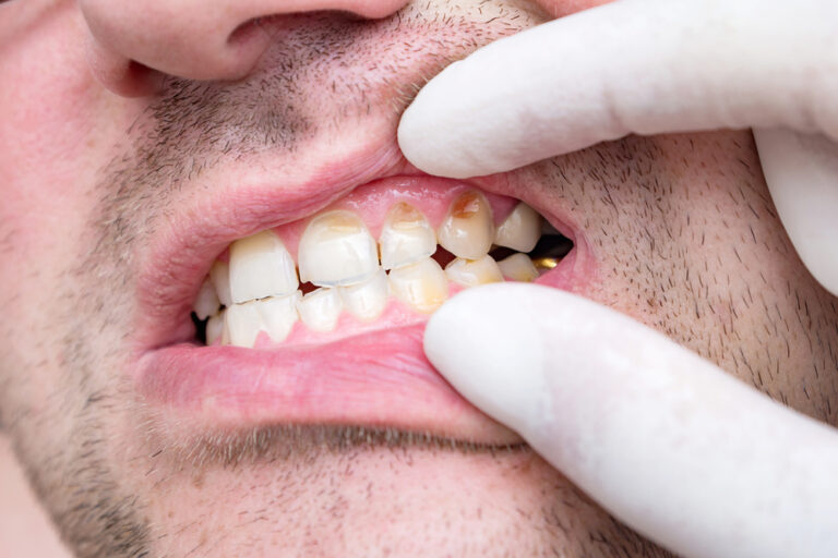 New research: Periodontitis may increase the risk of serious diseases