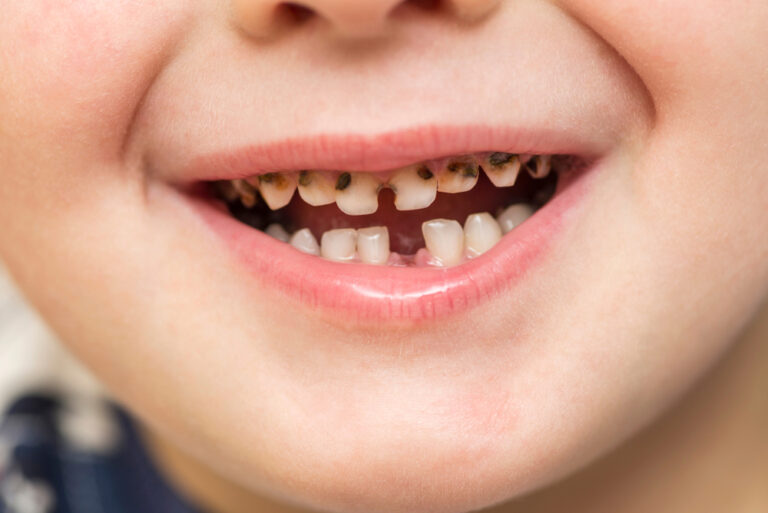 Dentist: Sugar is not the direct cause of cavities