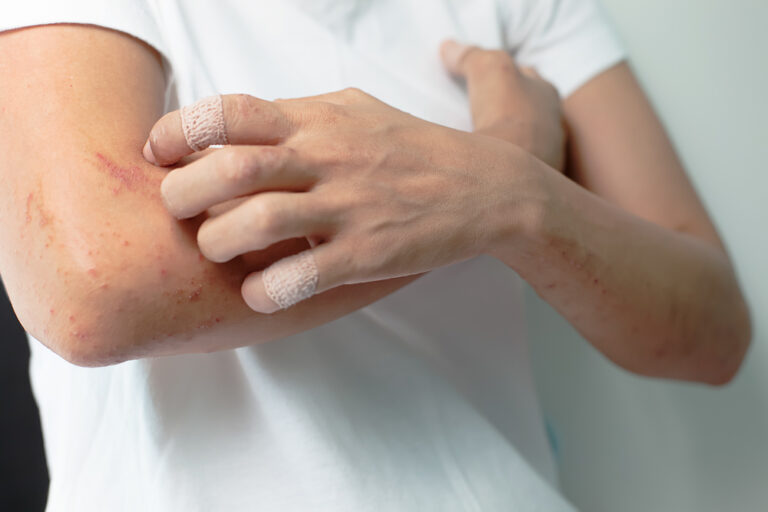 Dry patches and redness could be early warning signs