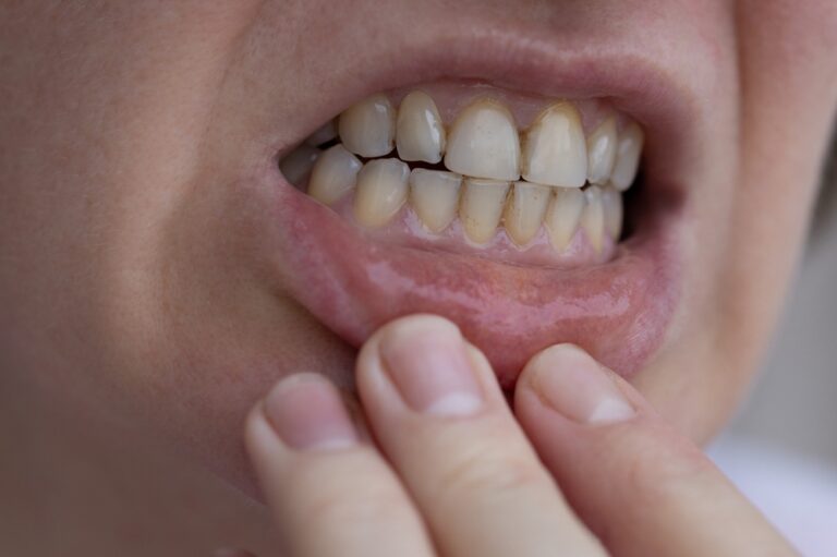Researchers develop a new way to whiten teeth without damaging them