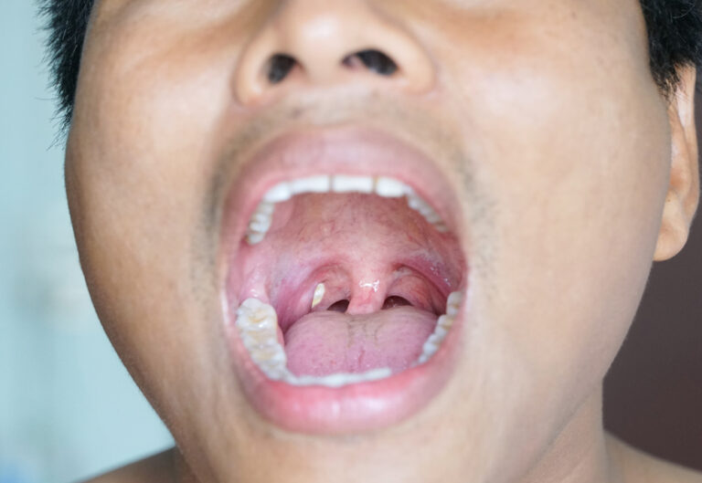 How to recognise early signs of cancer in the tonsils and tongue