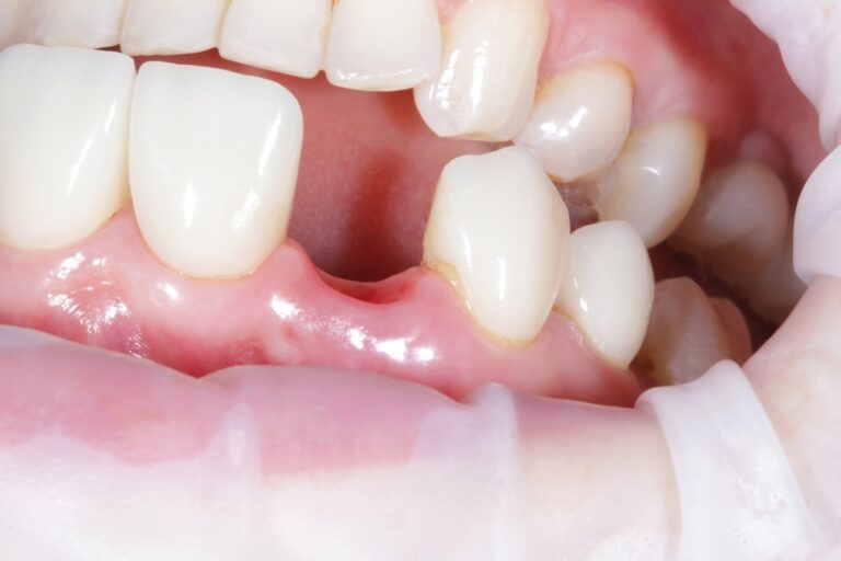 Missing teeth could lead to weight gain, study finds