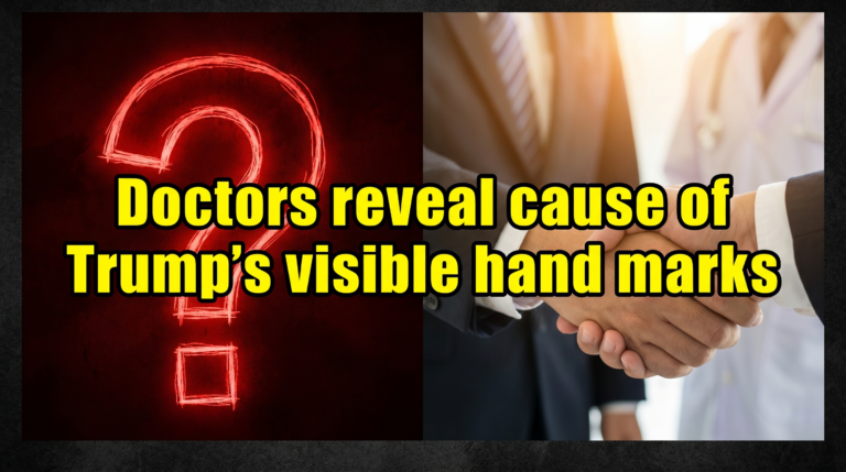 Thumbnail Doctors reveal cause of Trumps hand marks