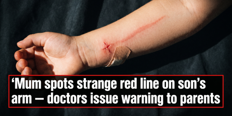 Thumbnail Mum spots strange red line on sons