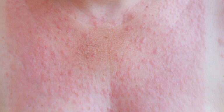 Why sun rash returns every summer – and here’s how to prevent it