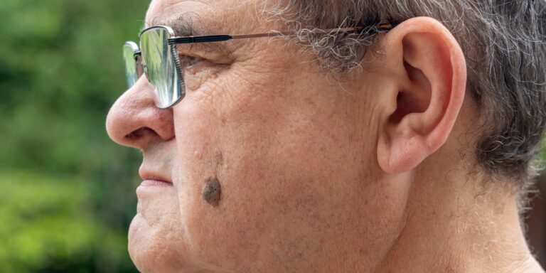 Early warning signs on your face that could signal dangerous cancer