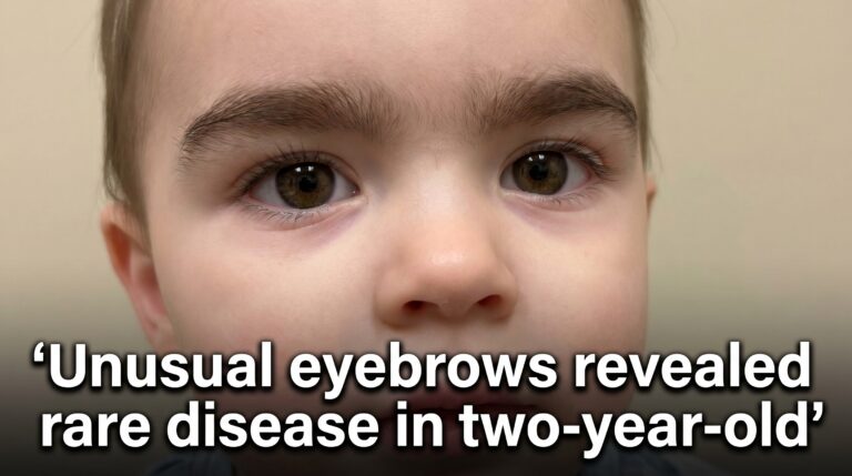Unusual eyebrows revealed rare disease in two-year-old
