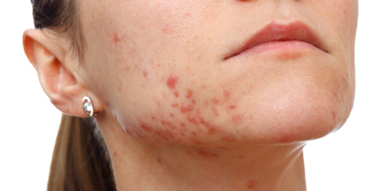 Skin problems may be affecting more than your appearance