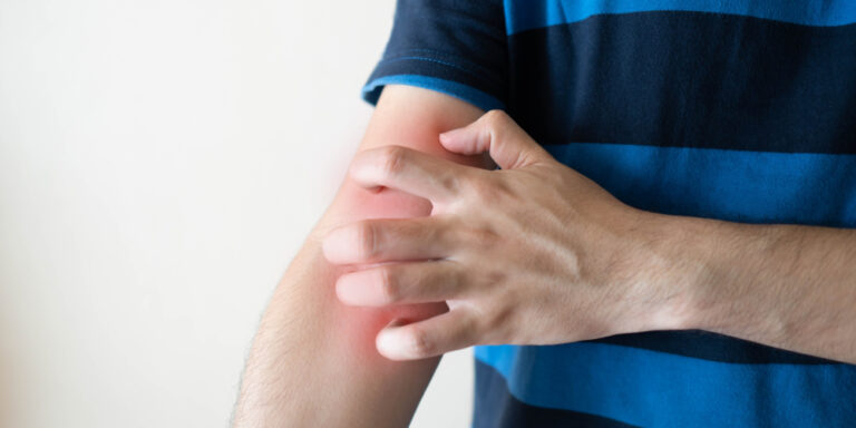 Why you get heat rash – and how to treat it