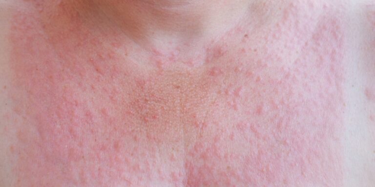 These types of medication can cause problems in the sun